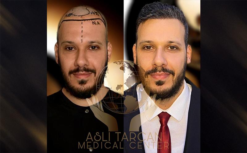 Top 10 Best Hair Transplant in Turkey: Clinics to Visit in 2026